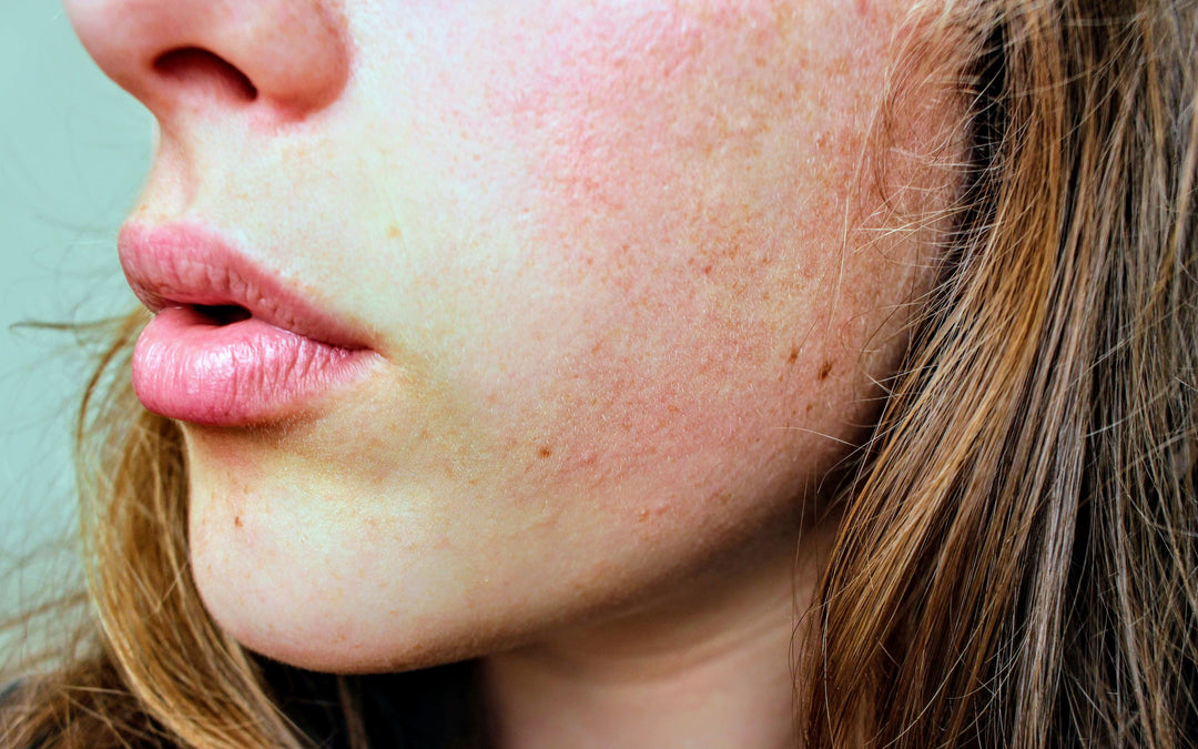 Close up of woman with rosacea prone skin