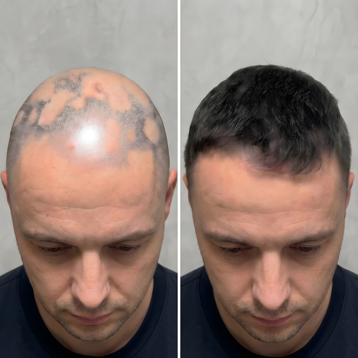 Pure Derma London Hair Growth High Strength Unisex LED Hair Growth Cap with Red Light & Deep Infrared Therapy
